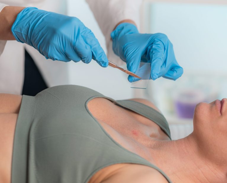 Dermatologist carefully extracts a skin sample during the procedure aimed at diagnosing and treating various skin conditions.