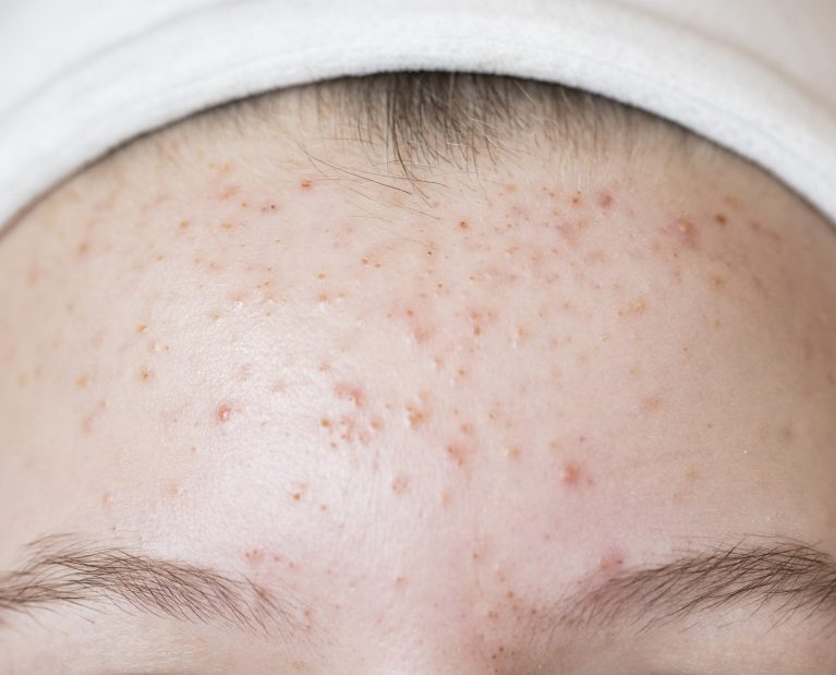 Teen girl with acne problem. Skin care concept with copy space